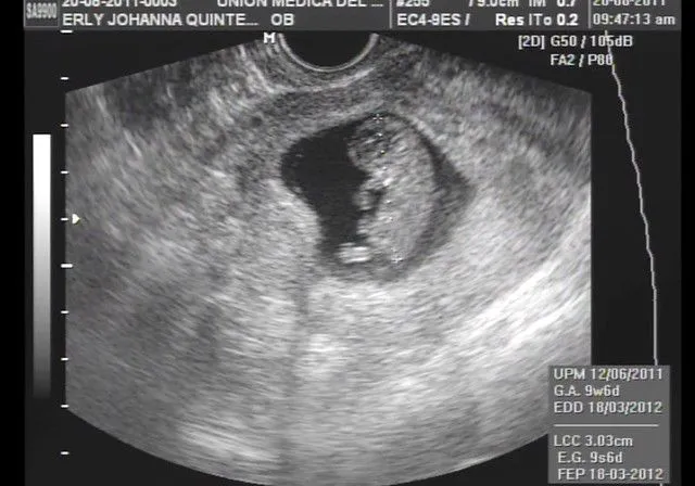 Ecografia obstetrica 6 semanas embarazo - Imagui
