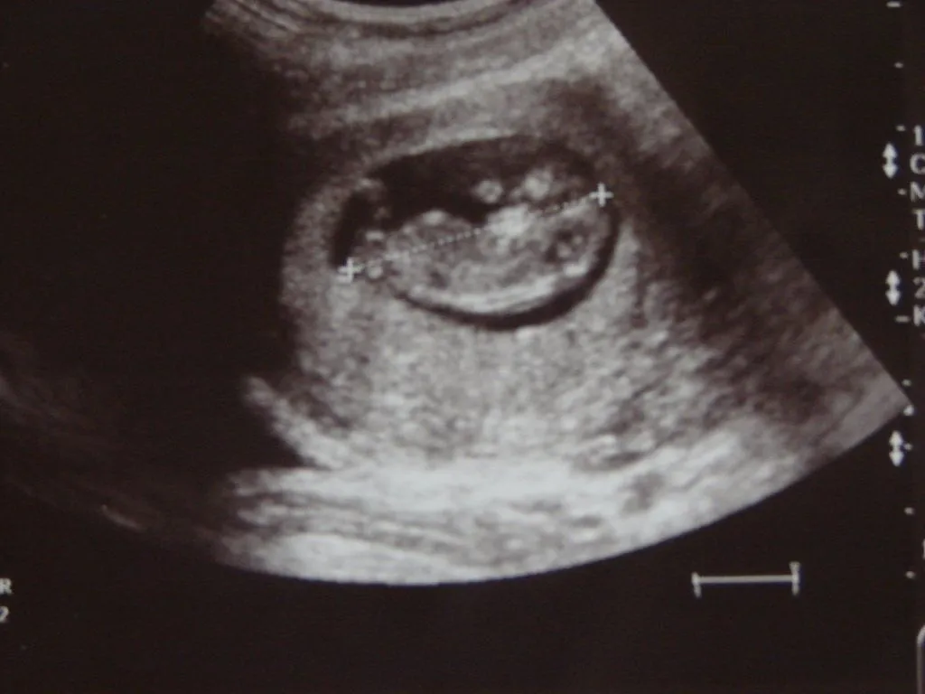 Ecografias de 2 meses de embarazo - Imagui