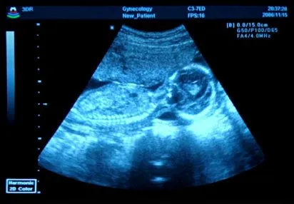 ecografia 5 semanas | Tener un bebé es facilisimo.com