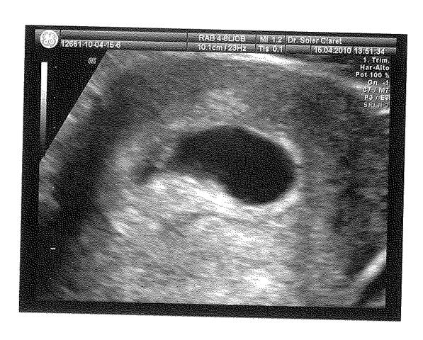 ecografia a las 4 semanas de embarazo - Imagui