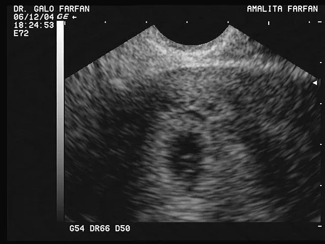 Semana 5 de embarazo ecografia - Imagui