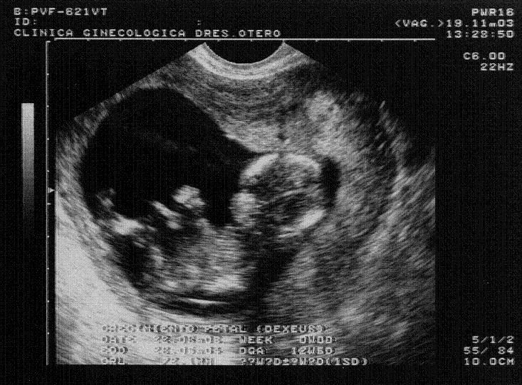 13 semanas de embarazo ecografia - Imagui
