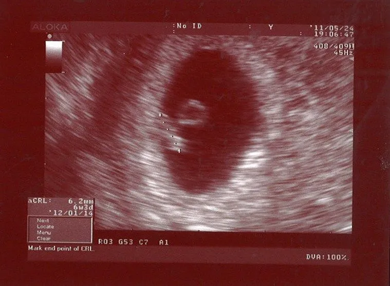 Ecografias de 6 semanas de embarazo - Imagui