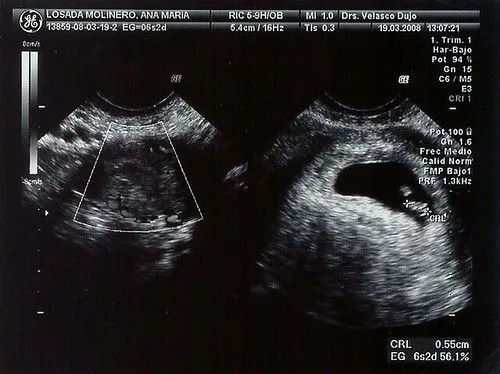 Imagenes de un embarazo de 6 semanas - Imagui