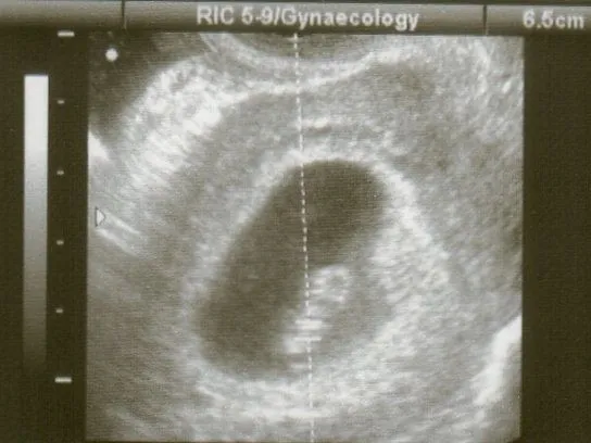 Primera ecografía del embarazo a las 7 semanas