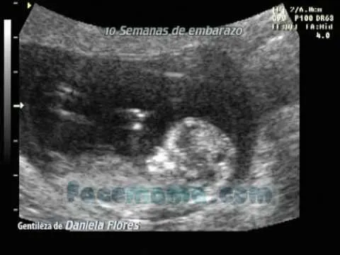 Ecografias 10 semanas de embarazo - Imagui
