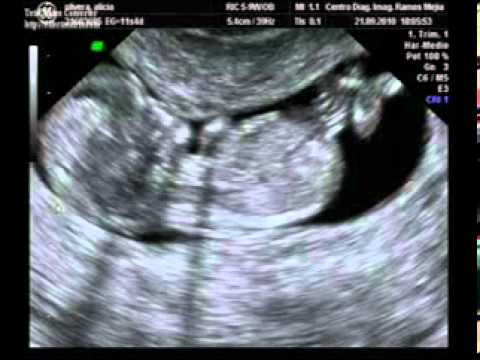 ecografia 11 + 3 semanas de embarazo - YouTube