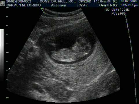 Ecografias 12 semanas de embarazo - Imagui