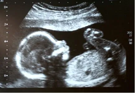Ecografias de 3 meses de embarazo varon - Imagui