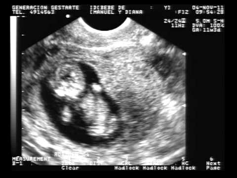 Embarazo de 11 semanas + 3 dias - YouTube