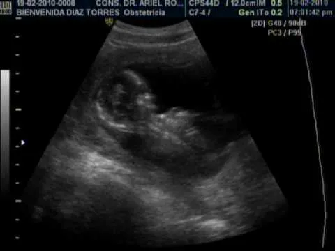 Embarazo de 13 semanas fotos - Imagui