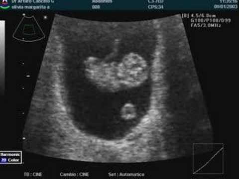 Embrion de 9 semanas en ecografia - Imagui