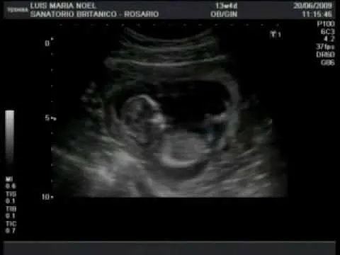 Embarazo. Ecografía 13 semanas y 4 días (¡Es un niño!) - YouTube