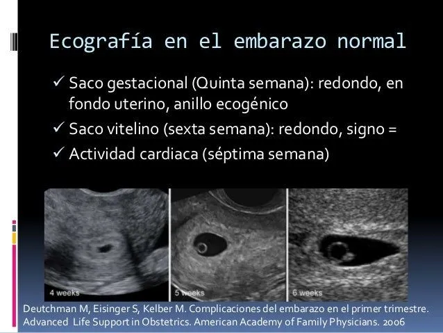 embarazo-ectopico-2013-2-638. ...