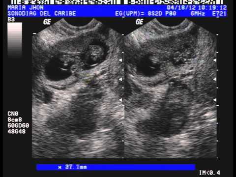 Embarazo Ectopico Gemelar - YouTube