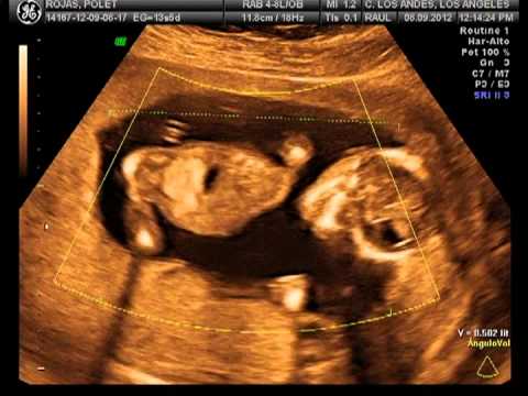 embarazo gemelar... segunda ecografia de mis gemelas!!! - YouTube