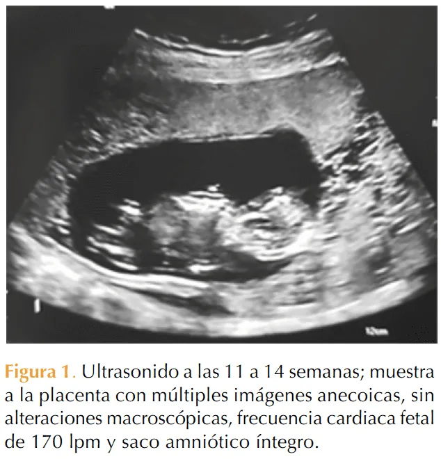 Embarazo gemelar con mola hidatiforme completa y feto vivo coexistente |  Revista de Ginecología y Obstetricia de México