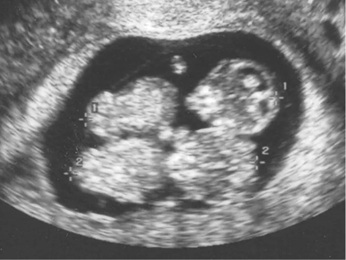 El embarazo gemelar monocorial monoamniótico - Somos Múltiples