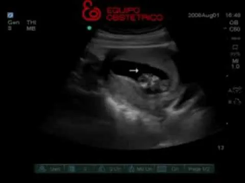 Embarazo gemelar de 6 semanas - Imagui