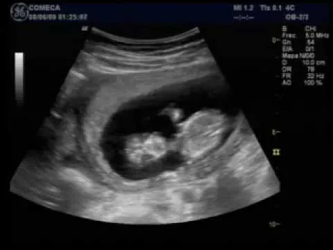Embarazo 3 meses ecografias - Imagui
