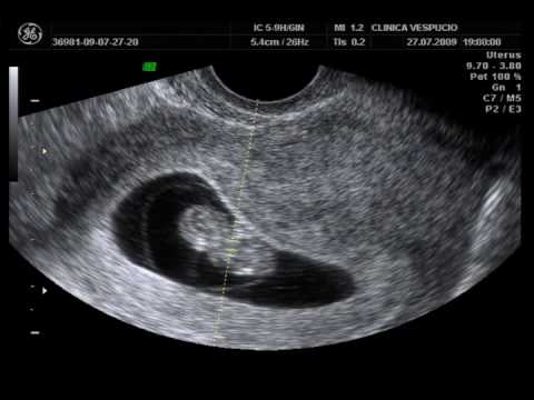 Semana ocho de embarazo ecografia - Imagui