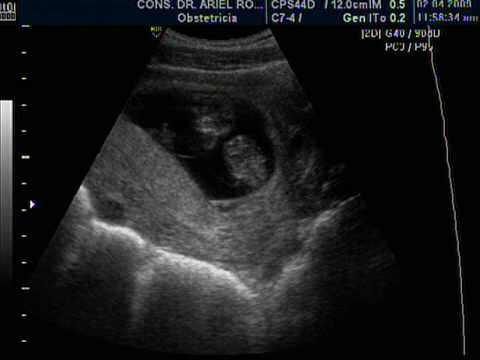Embarazo gemelar 5 semanas - Imagui