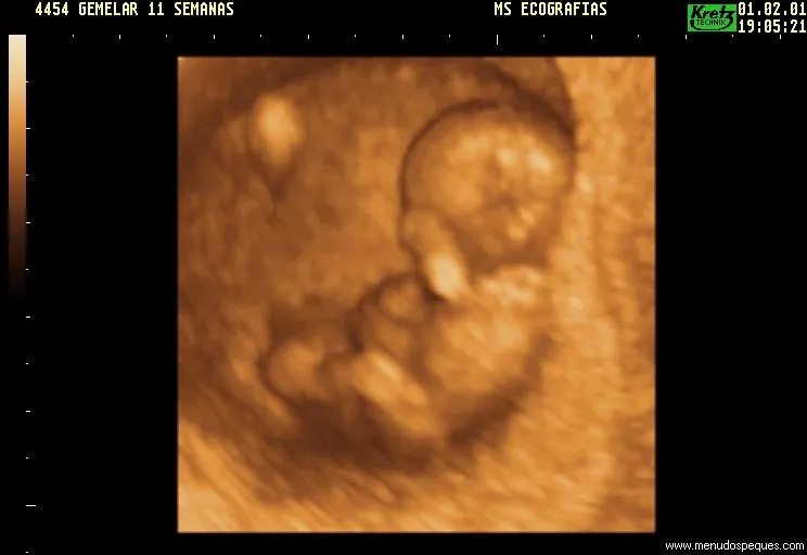 Fotos embrion 10 semanas - Imagui