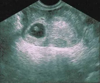 Un frijolito saltarín en mi vientre en la octava semana de embarazo