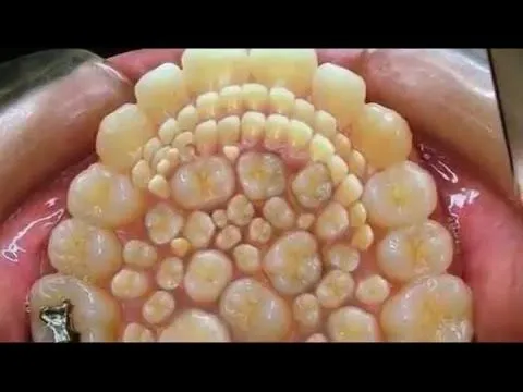 Extraen 232 dientes de la boca de un joven indio - YouTube