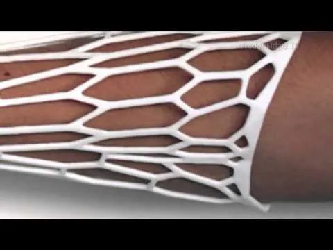 Una férula impresa en 3D que ayudará a sanar tu brazo roto - YouTube