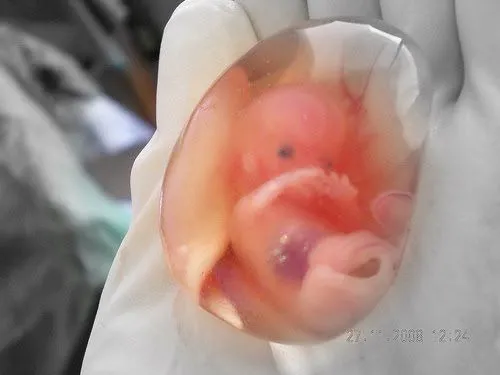 Foto de un feto vivo de 10 semanas en la mano de un médico - Foro ...