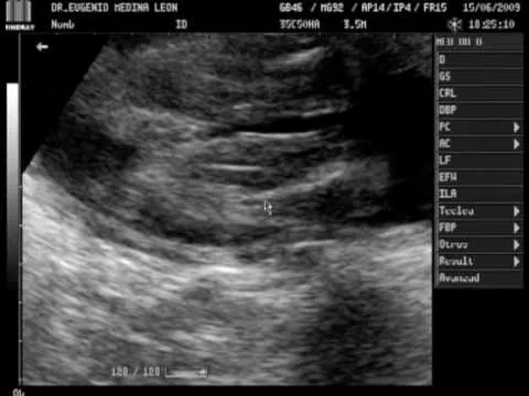 Foto de ultrasonido de bebé de 5 meses - Imagui