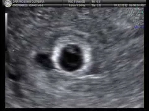 Gestação : 6 semanas e 1 dia - 30/12/2012 - YouTube