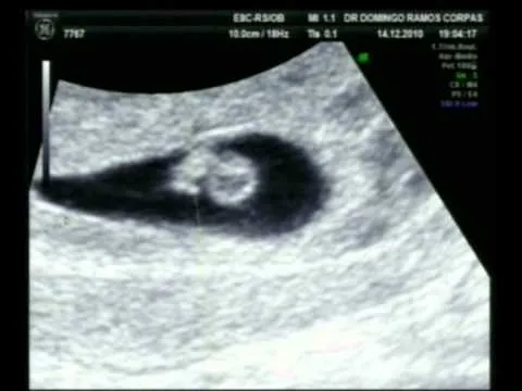 Gestación Gemelar Monocorial a las 6 semanas - YouTube