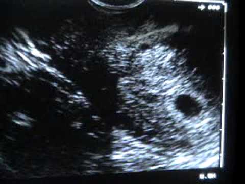 Gestación 4 semanas 6 días - Pregnancy 4 weeks 6 days - YouTube