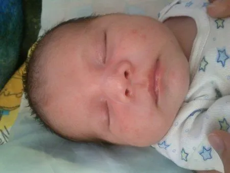 granitos en la cara - Bebés de Julio 2014 - BabyCenter
