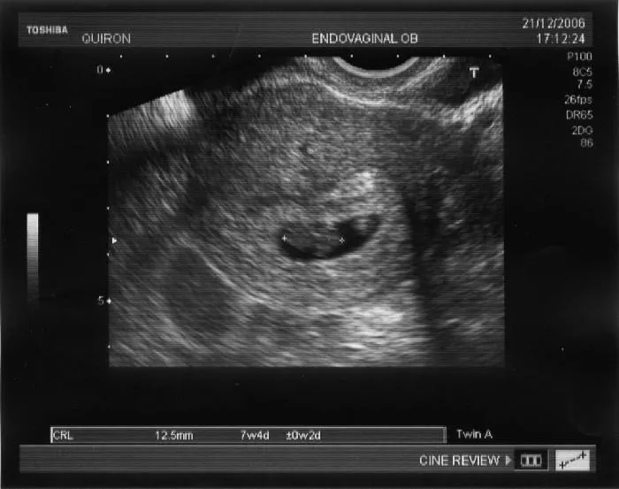  ... cruces es un feto de 7 semanas y 4 dias de embarazo unas 3 4 semanas