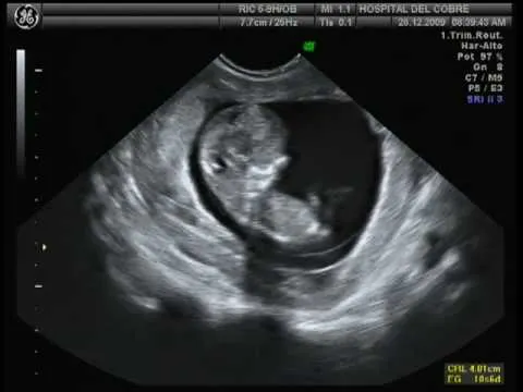 Como es un feto de 2 meses de gestacion - Imagui