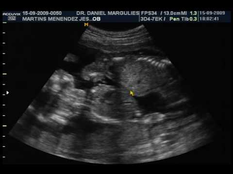 Buscar sonogramas de bebés gemelos de cuatro meses - Imagui