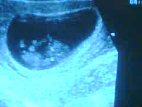 ultrasonido bebe 10 semanas de gestacion - YouTube