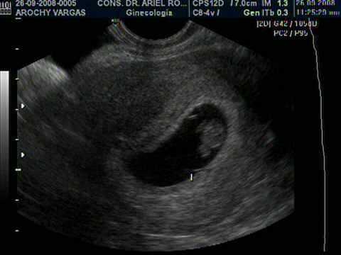 Ultrasonido de embarazo de 7 semanas - Imagui