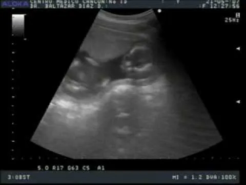 Ultrasonido de nuestro bebé a las 16 semanas. - YouTube