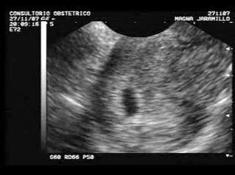 Fotos de ecografias de un mes de embarazo - Imagui