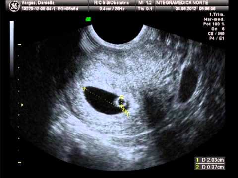 PRIMERA ECO 7 semanas de embarazo :D DANIELA & NICOLAS - YouTube