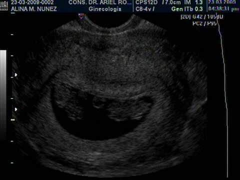 Embarazo gemelar 6 semanas - Imagui