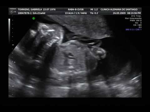 Ecografia 22 Semanas Embarazo - YouTube