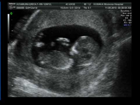 5 meses de gestacion bebé - Imagui