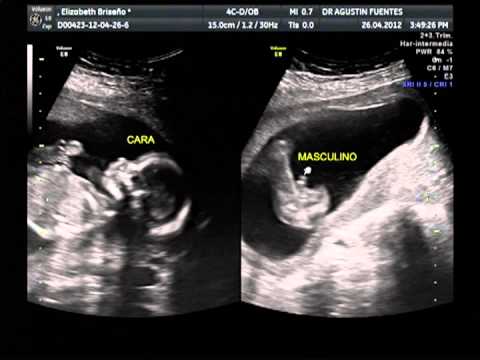 Ultrasonido de 3 meses de un niño - Imagui