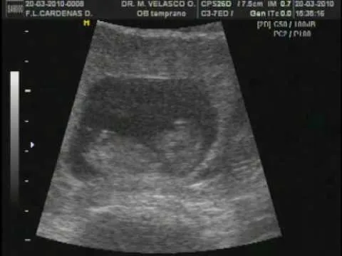 Ultrasonido de 3 meses y medio de embarazo - Imagui