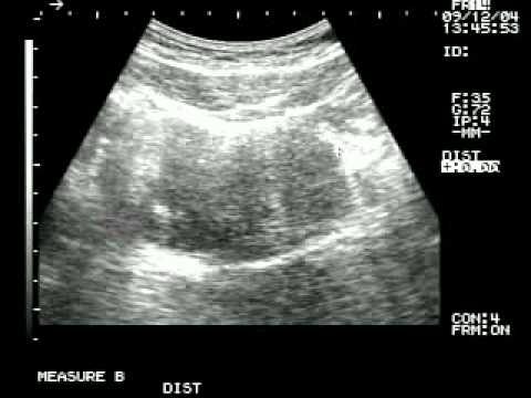 Ultrasonido de embarazo de un mes - Imagui